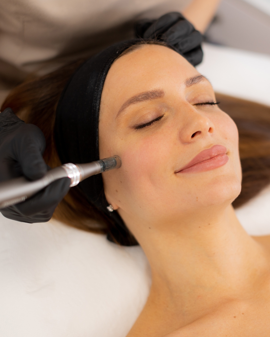 Microneedling-behandling hos The Glow Studio